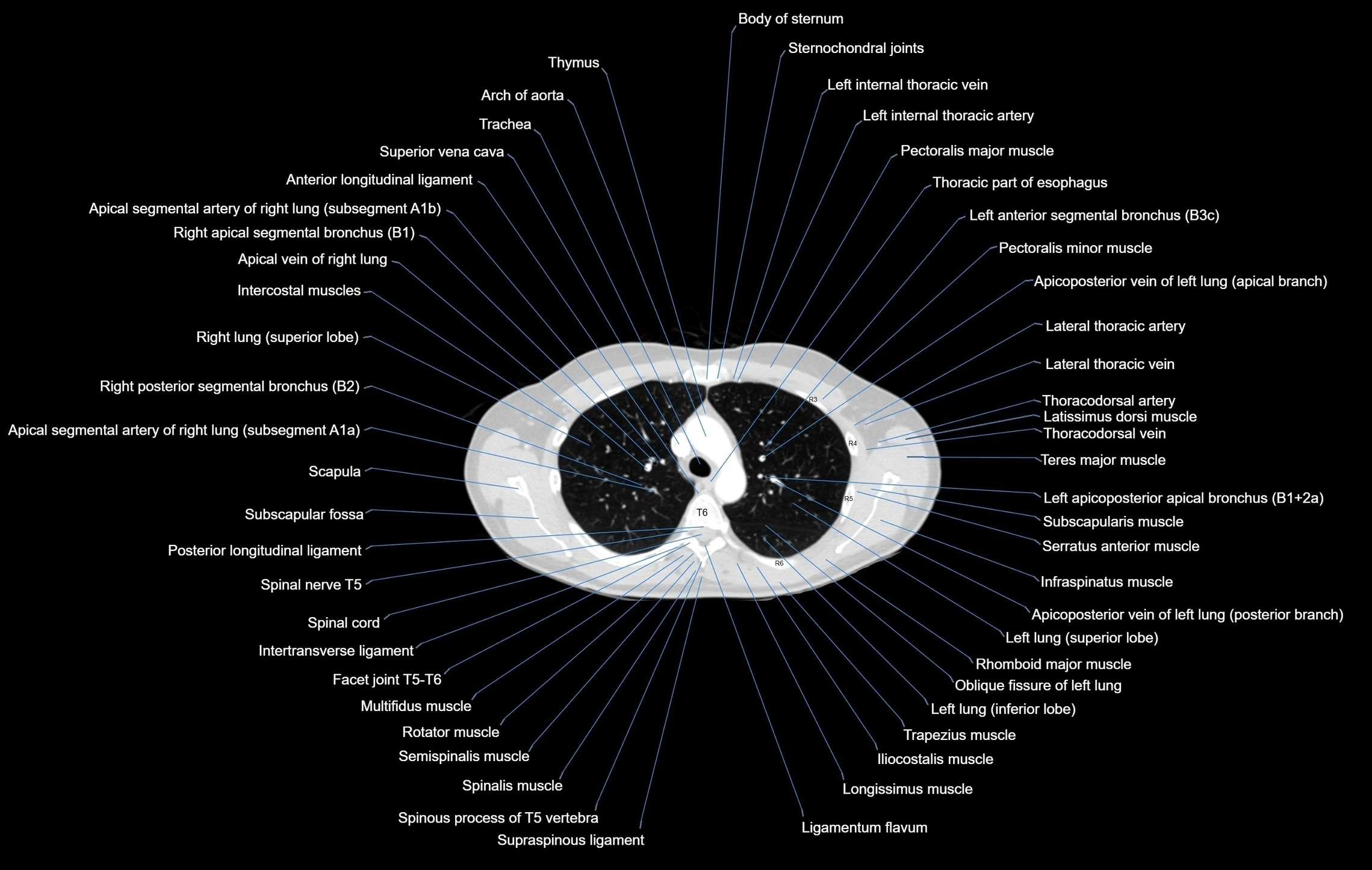 CT chest (thorax) labelled axial cross sectional anatomy radiology image-00039.webp